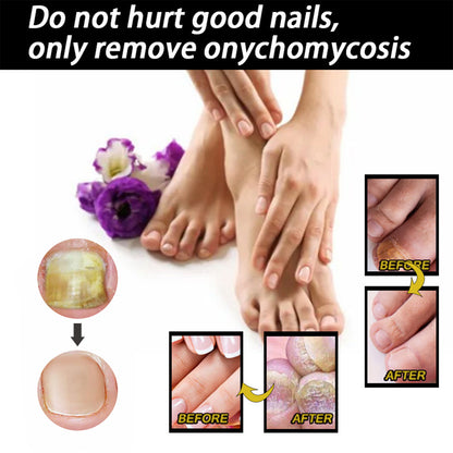 GDBadais Nail Repair Solution Thickening Brightening Nails Removing Gray Nails Dead Skin Repair Nourishing Nail Care Solution